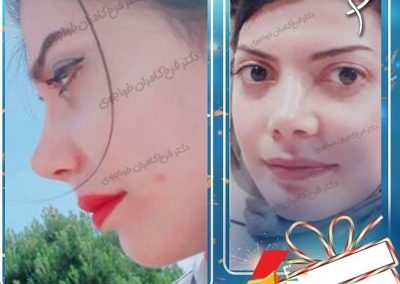 جراحی زیبایی بینی