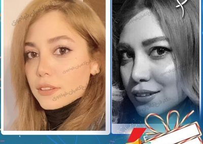 جراحی زیبایی بینی