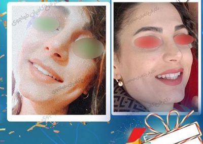 جراحی زیبایی بینی