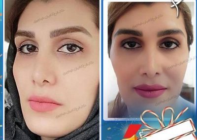 جراحی زیبایی بینی