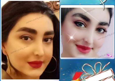 جراحی زیبایی بینی