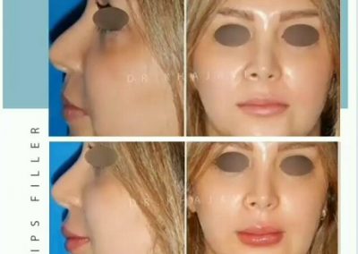 بلافاصله بعد از تزریق فیلر لب