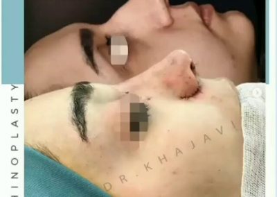 بلافاصله پس از عمل بینی
