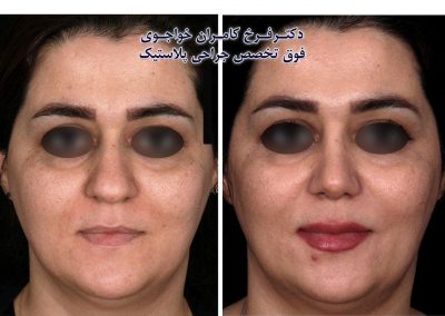 جراحی بینی