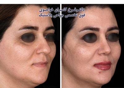 جراحی بینی