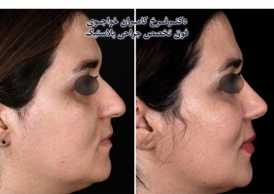 جراحی بینی