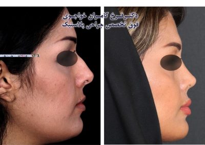 جراحی بینی در گرگان