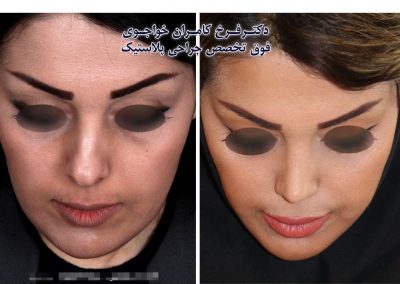 جراحی بینی در گرگان