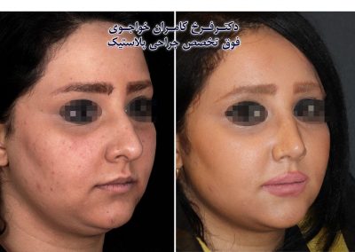 جراحی بینی فانتزی