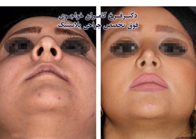 جراحی بینی فانتزی