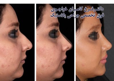 جراحی بینی فانتزی