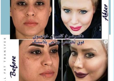 جراحی زیبایی بینی