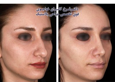 جراحی زیبایی بینی