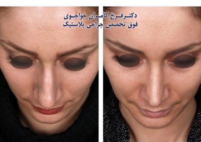 جراحی زیبایی بینی