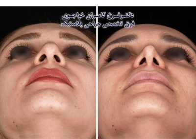 جراحی زیبایی بینی
