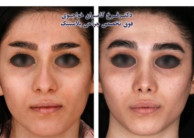 عمل بینی