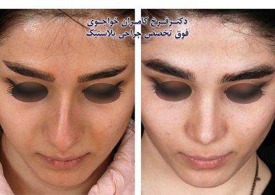 عمل بینی