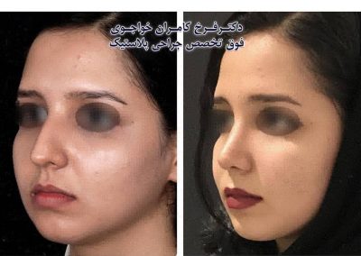 عمل جراحی بینی