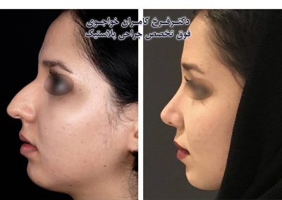 عمل جراحی بینی