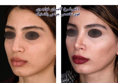 نتیجه جراحی بینی