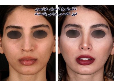نتیجه جراحی بینی