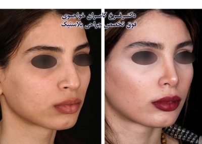 نتیجه جراحی بینی