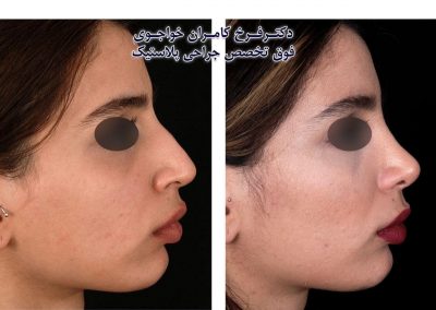 نتیجه جراحی بینی