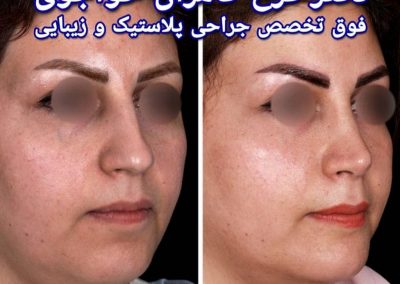نتیجه عمل بینی