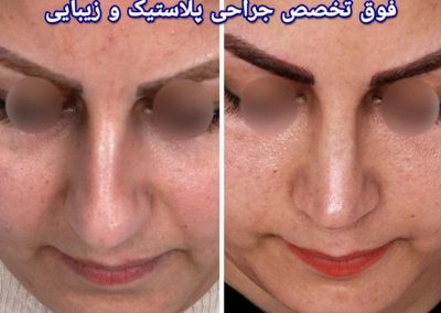 نتیجه عمل بینی