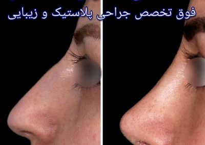 نتیجه عمل بینی