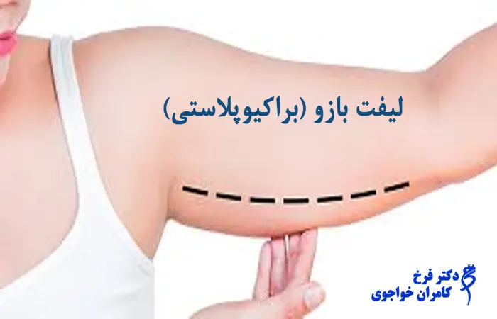 براکیوپلاستی