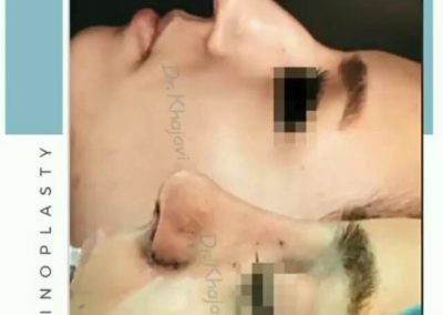 عمل زیبایی بینی بلافاصله بعد از جراحی