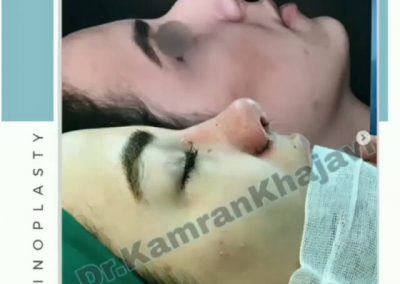 نتیجه جراحی زیبایی بینی