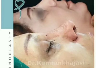 جراحی رینوپلاستی ثانویه اصلاح افتادگی، ارتفاع زیاد، کجی نوک بینی و عدم تقارن سوراخهای بینی