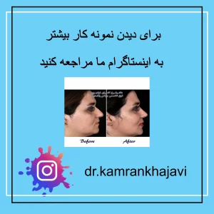 نمونه کار جراحی بینی
