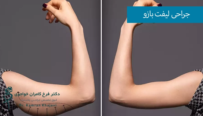 هدف از انجام جراحی لیفت بازو