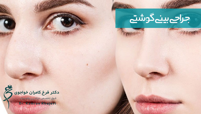 جراحی بینی گوشتی 