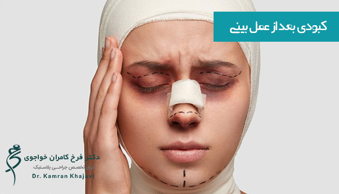 علت کبودی بعد از عمل بینی