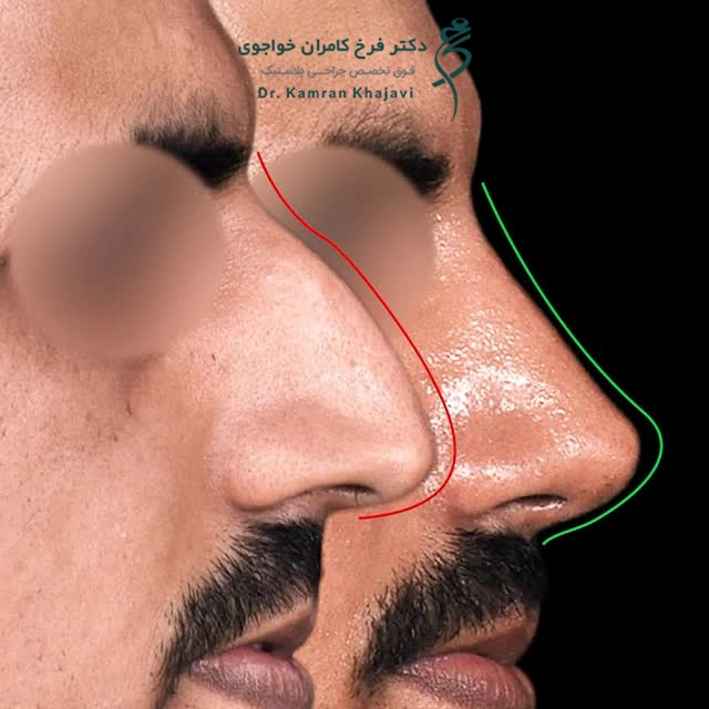 نمونه جراحی بینی دکتر فرخ کامران خواجوی