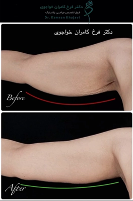 لیفت بازو با رنوویون برای چه کسانی مناسب است؟