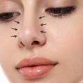 جراحی بینی گوشتی در گرگان